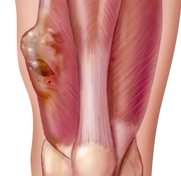 Best Soft Tissue Tumor Oncosurgeon in Mumbai