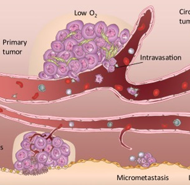 Best Doctor For Bone Metastases Treatment in Mumbai